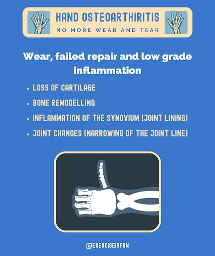 Hand arthritis Blog by MSK Playbook