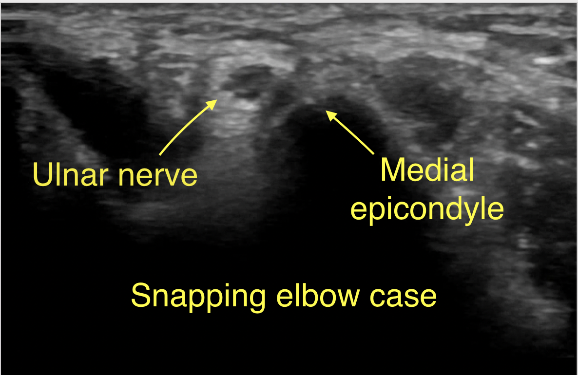 Irfan shows us an ultrasound case of a snapping elbow!
