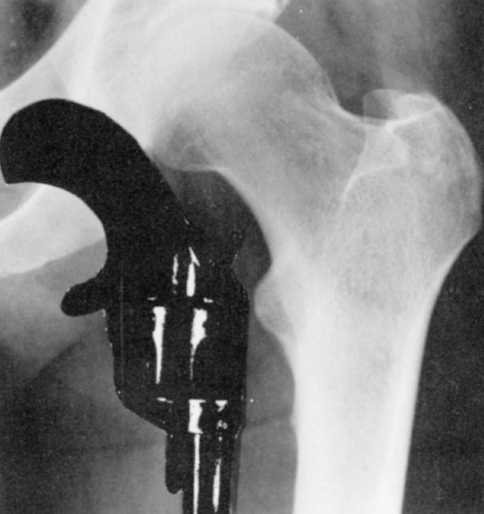 Rotator cuff tears & tendinopathy Blog by MSK Playbook